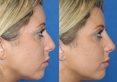 Non-Surgical Rhinoplasty Before & After Gallery - Patient 71702278 - Image 1