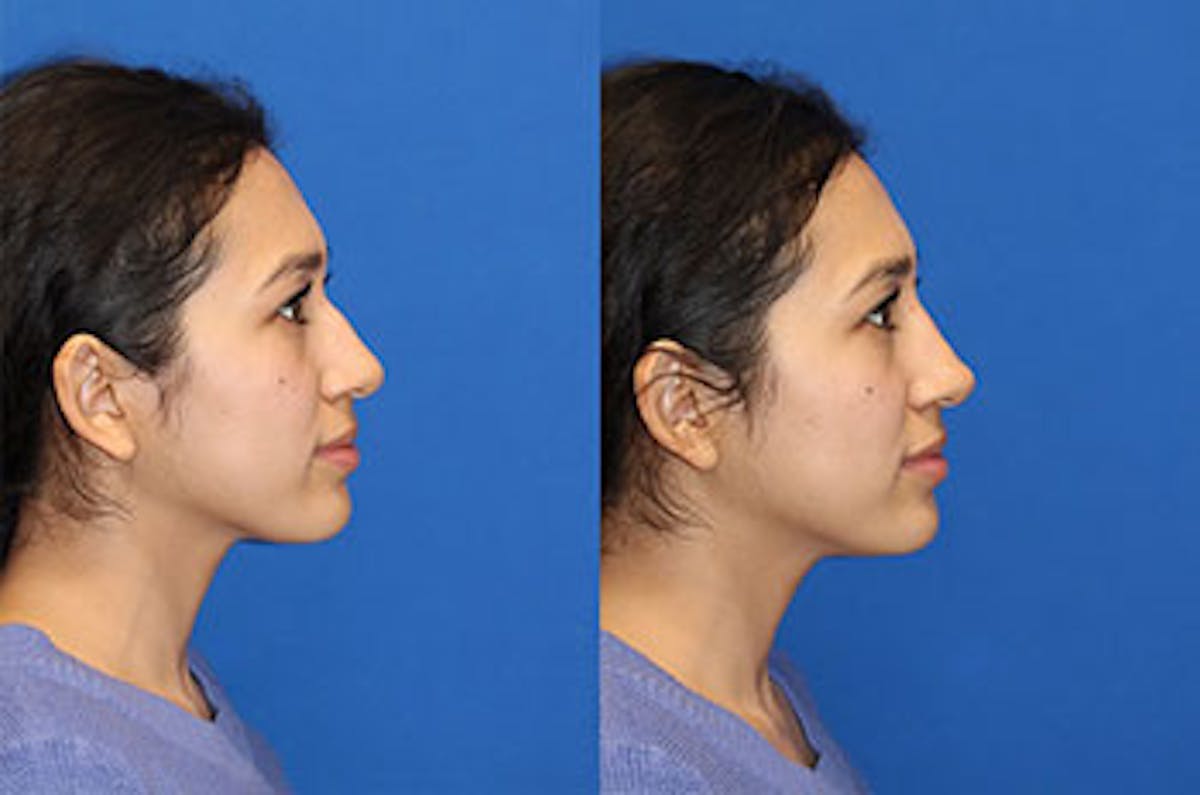 Non-Surgical Rhinoplasty Before & After Gallery - Patient 71702280 - Image 1