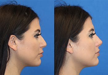 Non-Surgical Rhinoplasty Before & After Gallery - Patient 71702281 - Image 1