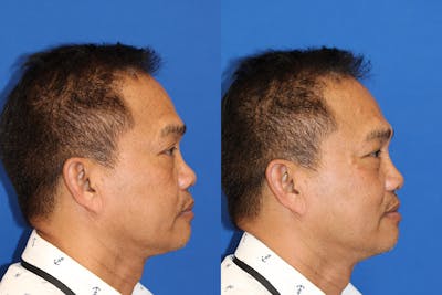 Non-Surgical Rhinoplasty Before & After Gallery - Patient 71702288 - Image 1