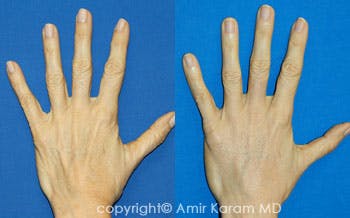 Hand Rejuvenation Before & After Gallery - Patient 71702454 - Image 1
