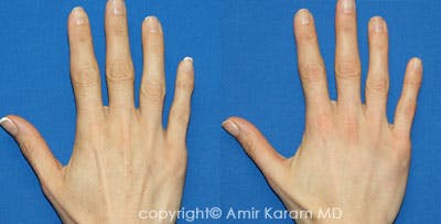 Hand Rejuvenation Before & After Gallery - Patient 71702455 - Image 1