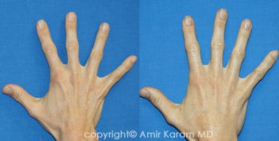 Hand Rejuvenation Before & After Gallery - Patient 71702456 - Image 1