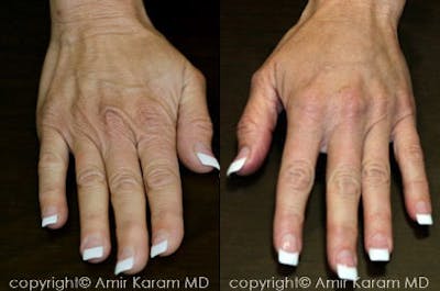 Hand Rejuvenation Before & After Gallery - Patient 71702457 - Image 1