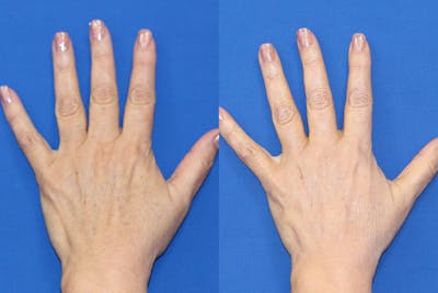 Hand Rejuvenation Before & After Gallery - Patient 71702464 - Image 1