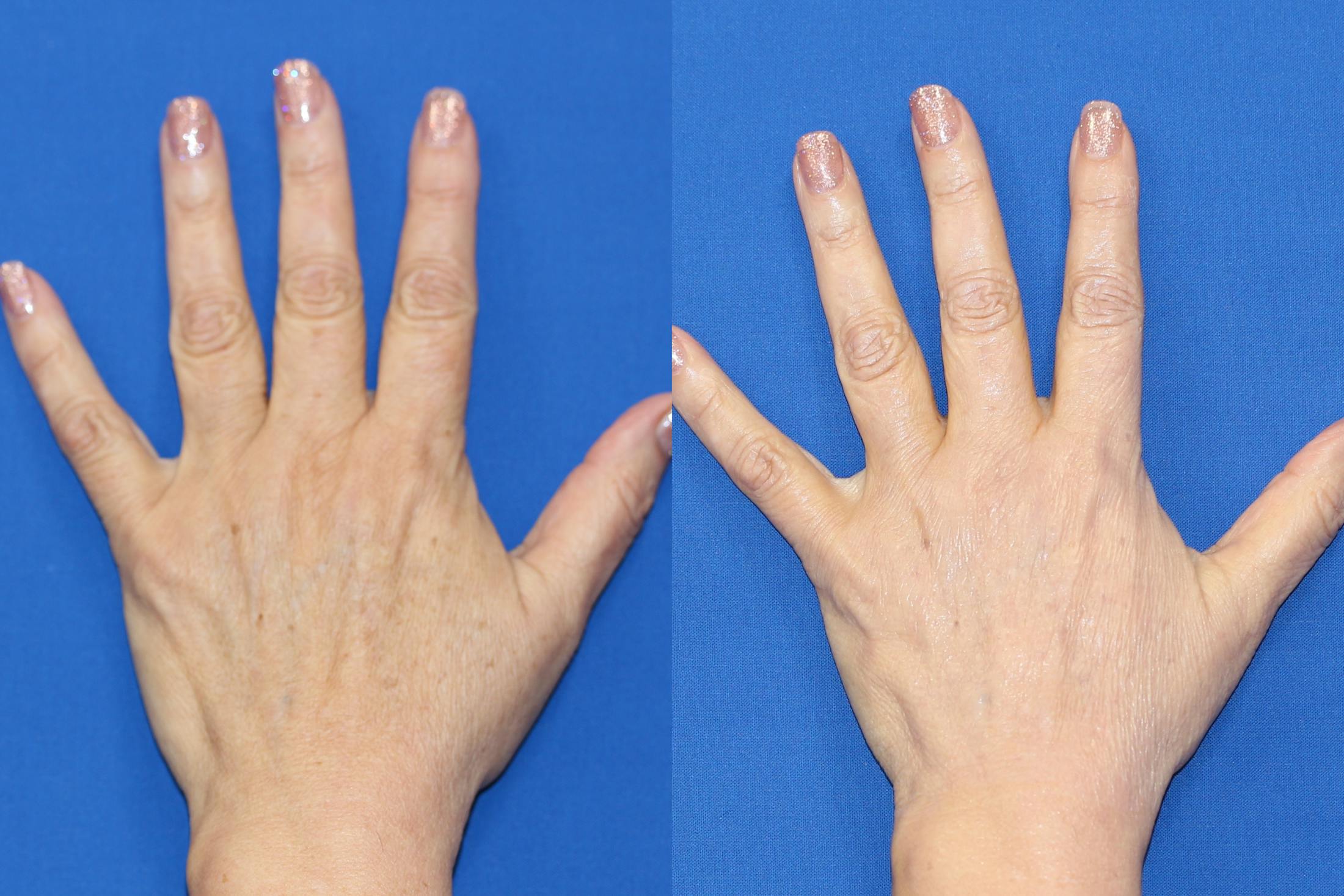 Hand Rejuvenation Before & After Gallery - Patient 71702464 - Image 1