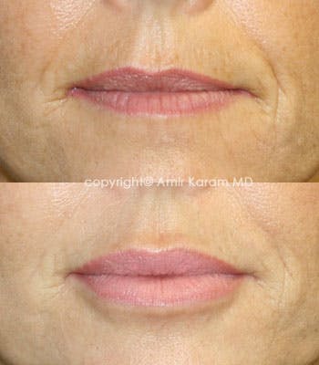 Lip Augmentation