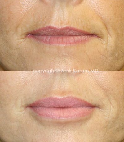 Lip Augmentation Before & After Gallery - Patient 71702460 - Image 1