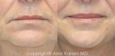 Lip Augmentation Before & After Gallery - Patient 71702463 - Image 1