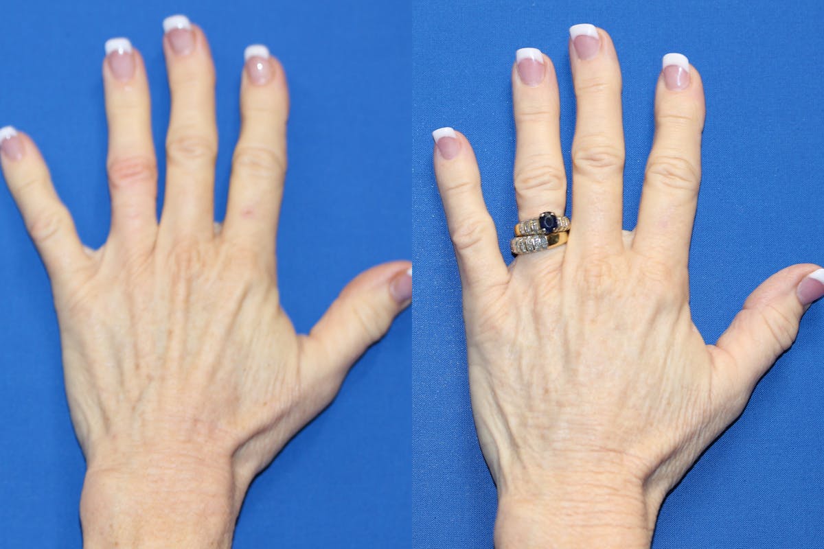 Hand Rejuvenation Before & After Gallery - Patient 71702468 - Image 1