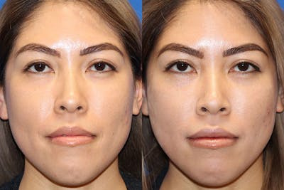 Lip Augmentation Before & After Gallery - Patient 71702469 - Image 1