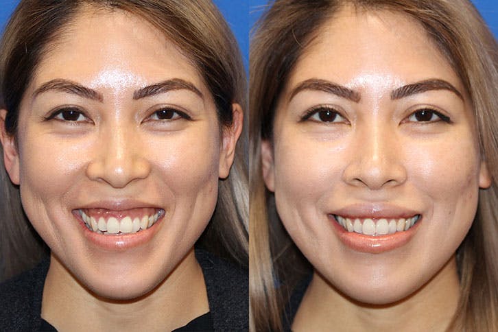 Lip Augmentation Before & After Gallery - Patient 71702469 - Image 2