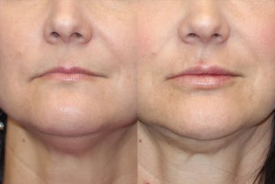 Lip Augmentation Before & After Gallery - Patient 71702470 - Image 1