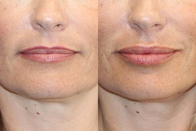 Lip Augmentation Before & After Gallery - Patient 71702471 - Image 1