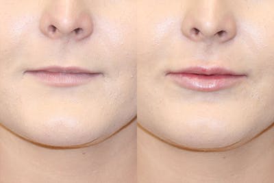 Lip Augmentation Before & After Gallery - Patient 71702472 - Image 1
