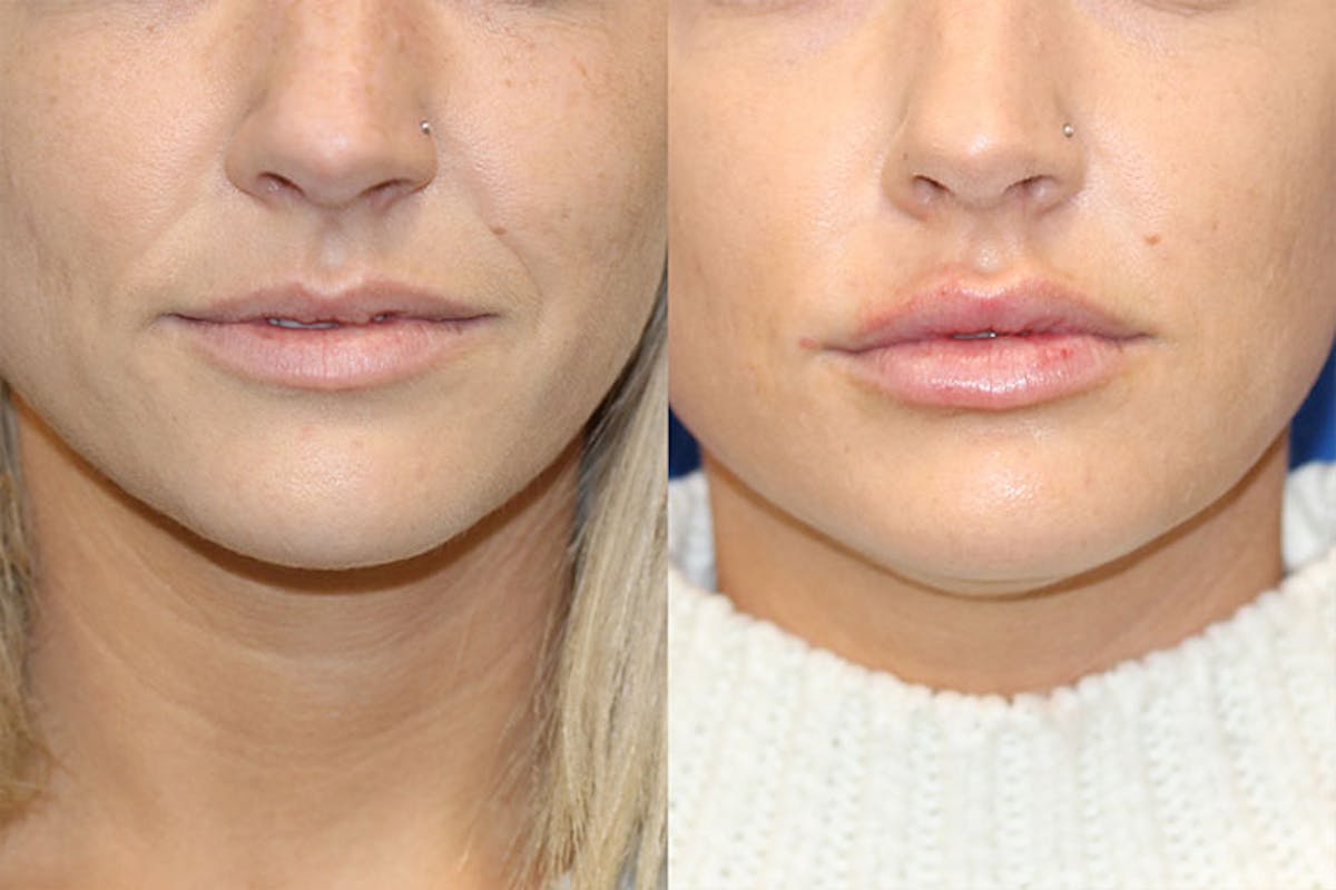 Lip Augmentation Before & After Gallery - Patient 71702482 - Image 1