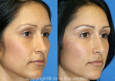 Fat Transfer Before & After Gallery - Patient 71703751 - Image 1