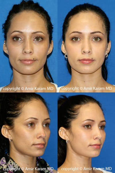 Fat Transfer Before & After Gallery - Patient 71703831 - Image 1