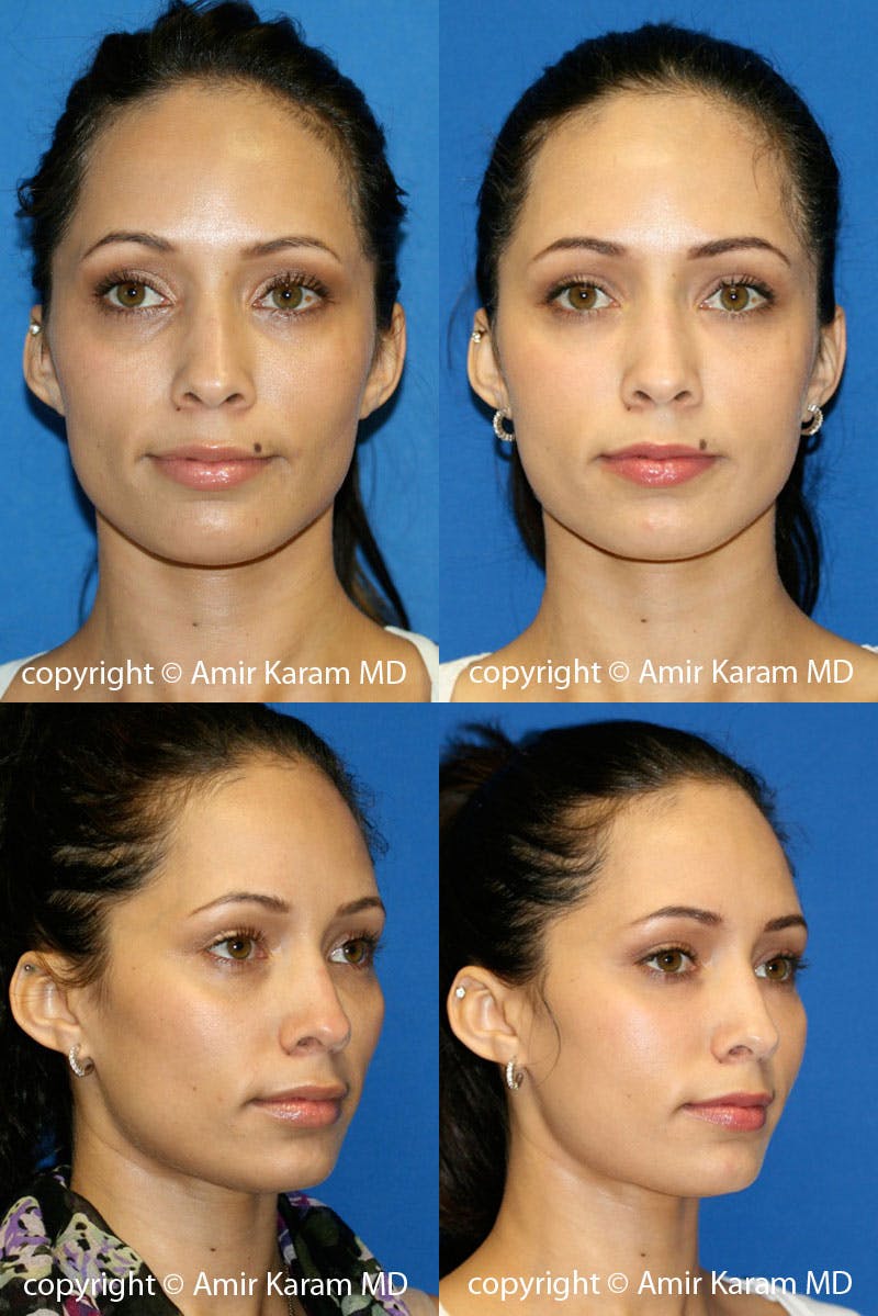 Fat Transfer Before & After Gallery - Patient 71703831 - Image 1