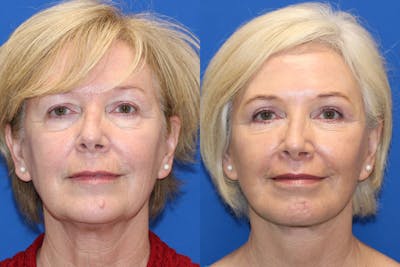 Fat Transfer Before & After Gallery - Patient 71703833 - Image 1