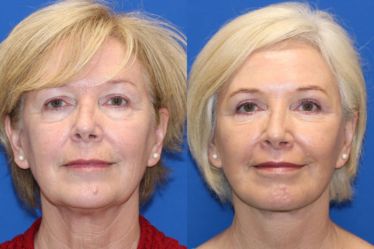 Fat Transfer Before & After Gallery - Patient 71703833 - Image 1