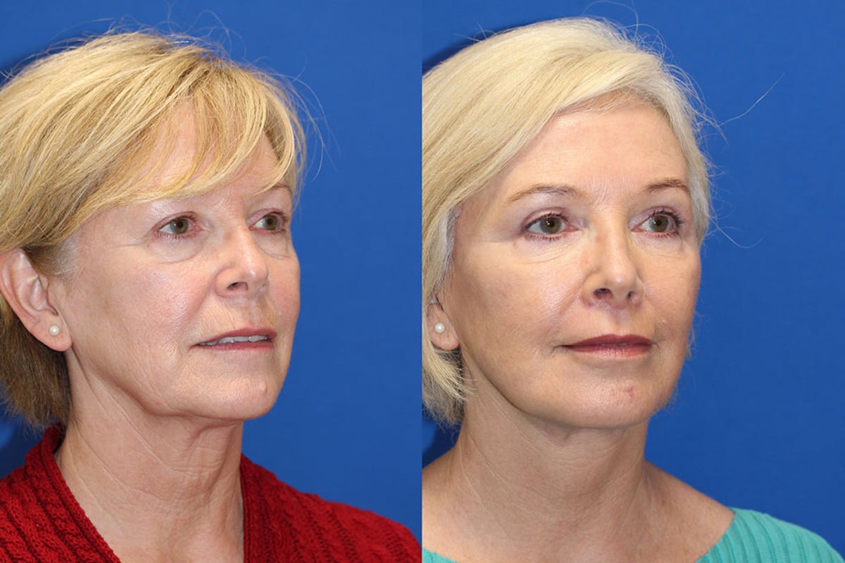 Fat Transfer Before & After Gallery - Patient 71703833 - Image 2