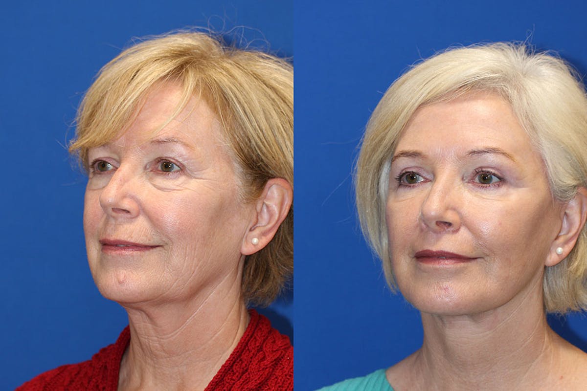 Fat Transfer Before & After Gallery - Patient 71703833 - Image 3