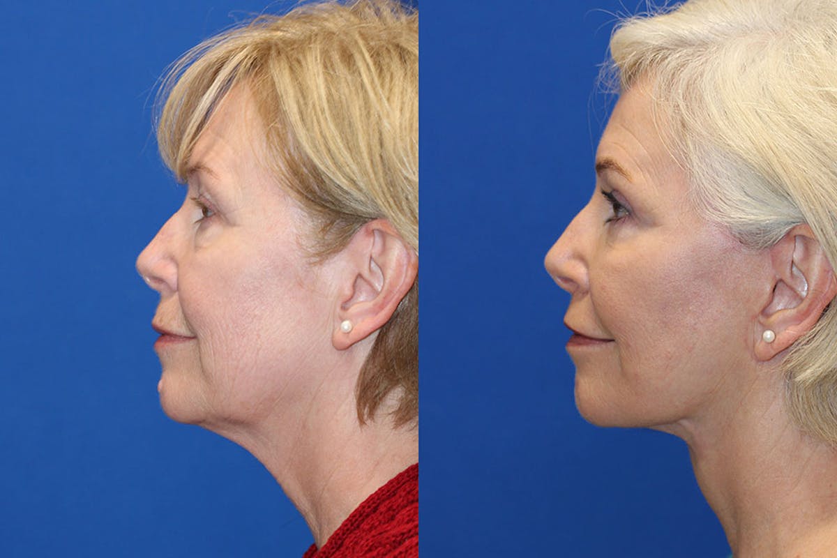 Fat Transfer Before & After Gallery - Patient 71703833 - Image 4