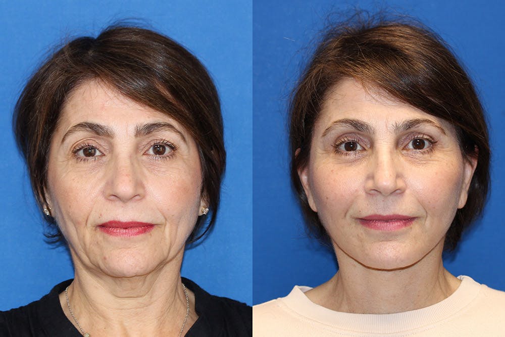Fat Transfer Before & After Gallery - Patient 71703834 - Image 2