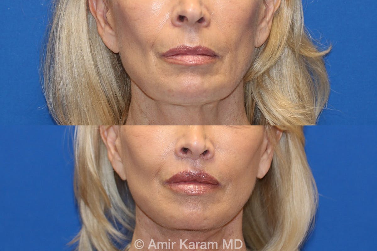 Fat Transfer Before & After Gallery - Patient 71703846 - Image 1