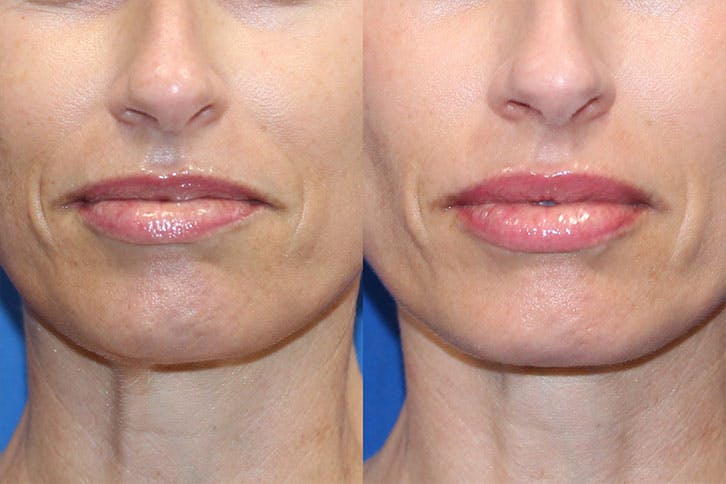 Lip Augmentation Before & After Gallery - Patient 71709402 - Image 1