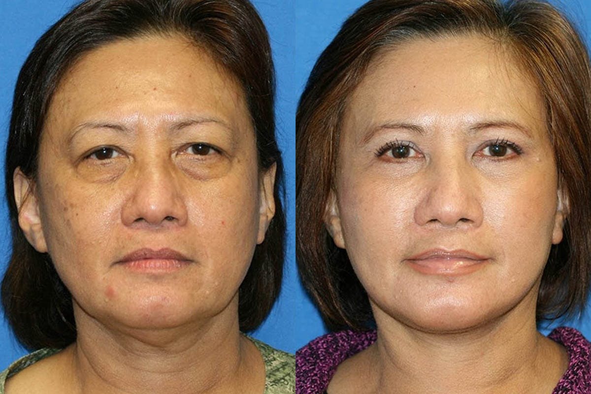 Vertical Restore® / Facial Rejuvenation Before & After Gallery - Patient 71700713 - Image 1