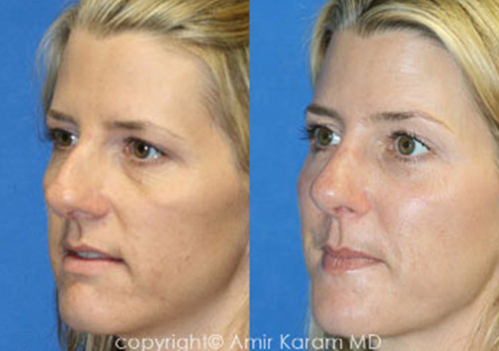 Chemical Peels Gallery - Patient 71701633 - Image 1