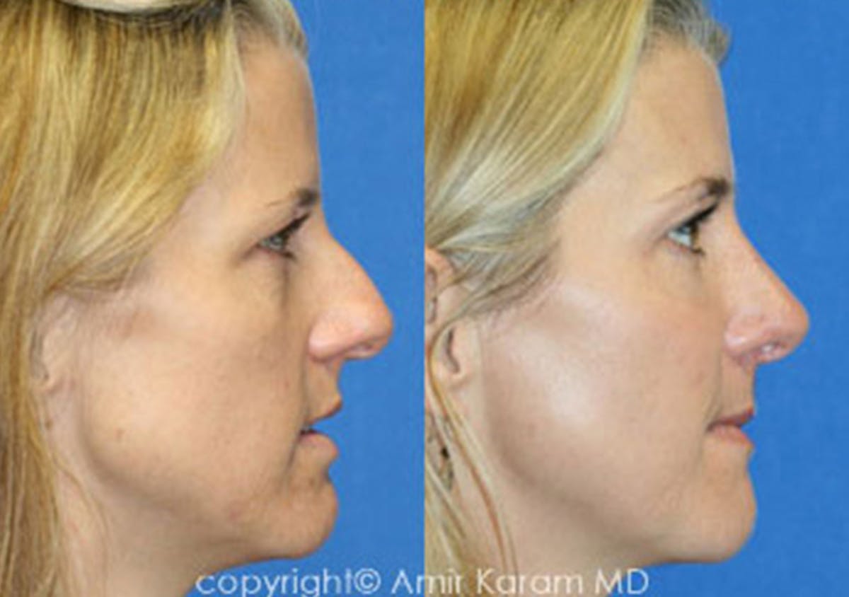Chemical Peels Before & After Gallery - Patient 71701633 - Image 2