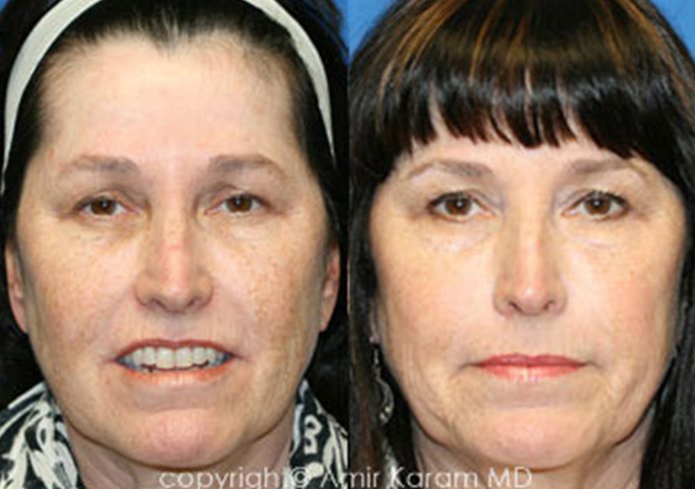 Chemical Peels Before & After Gallery - Patient 71701634 - Image 1