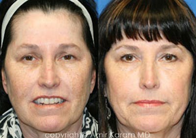 Chemical Peels Before & After Gallery - Patient 71701634 - Image 1