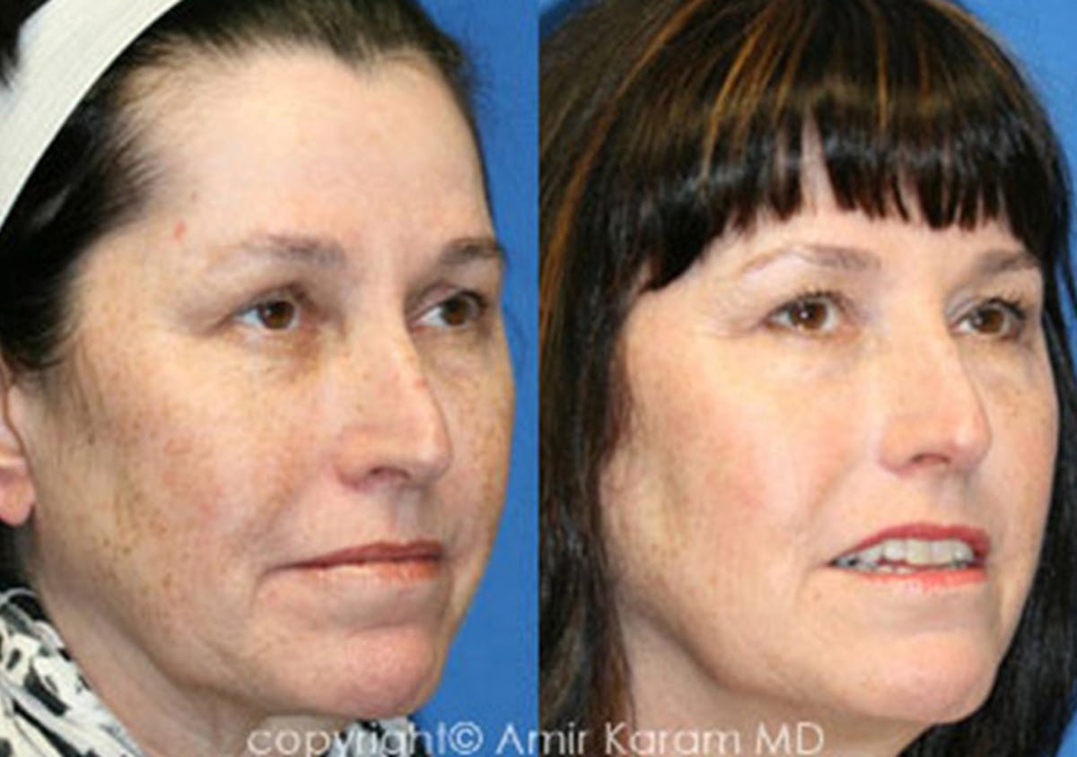 Chemical Peels Before & After Gallery - Patient 71701634 - Image 2