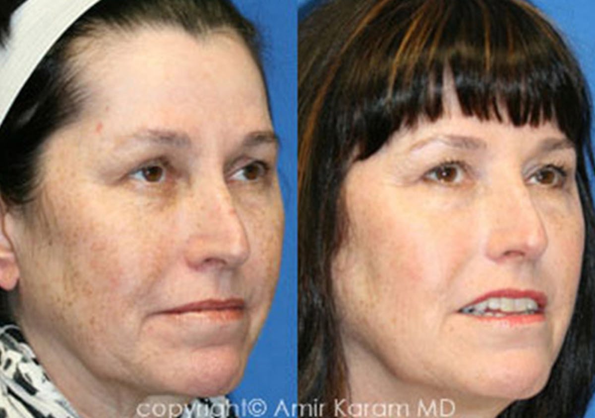 Patient 71701634 Chemical Peels Before & After Photos Carmel Valley