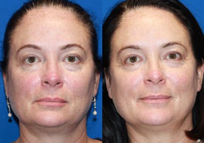 Chemical Peels Before & After Gallery - Patient 71709343 - Image 1