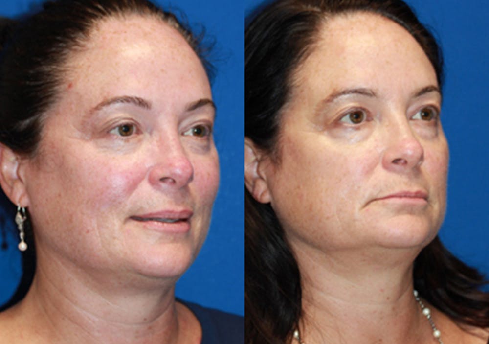 Chemical Peels Gallery - Patient 71709343 - Image 2