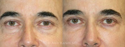 Eye Rejuvenation Before & After Gallery - Patient 71700120 - Image 1