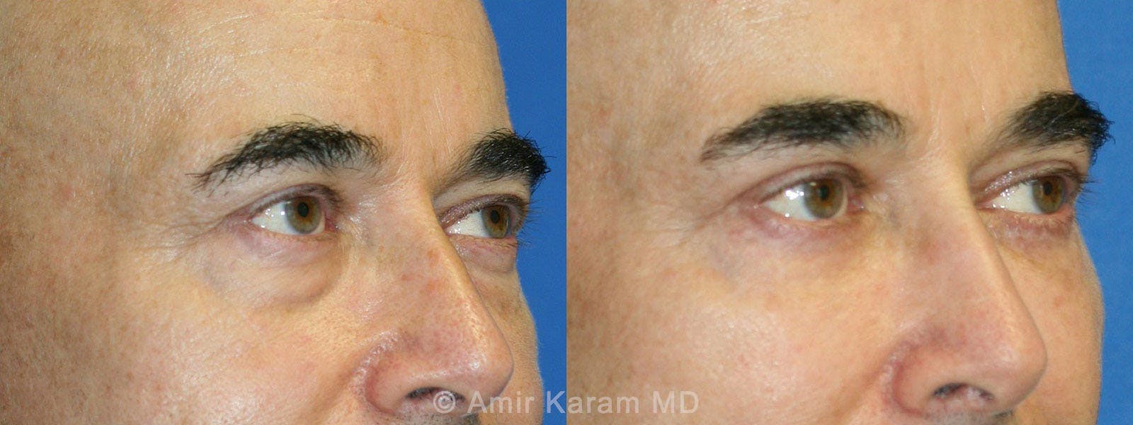 Eye Rejuvenation Before & After Gallery - Patient 71700120 - Image 2