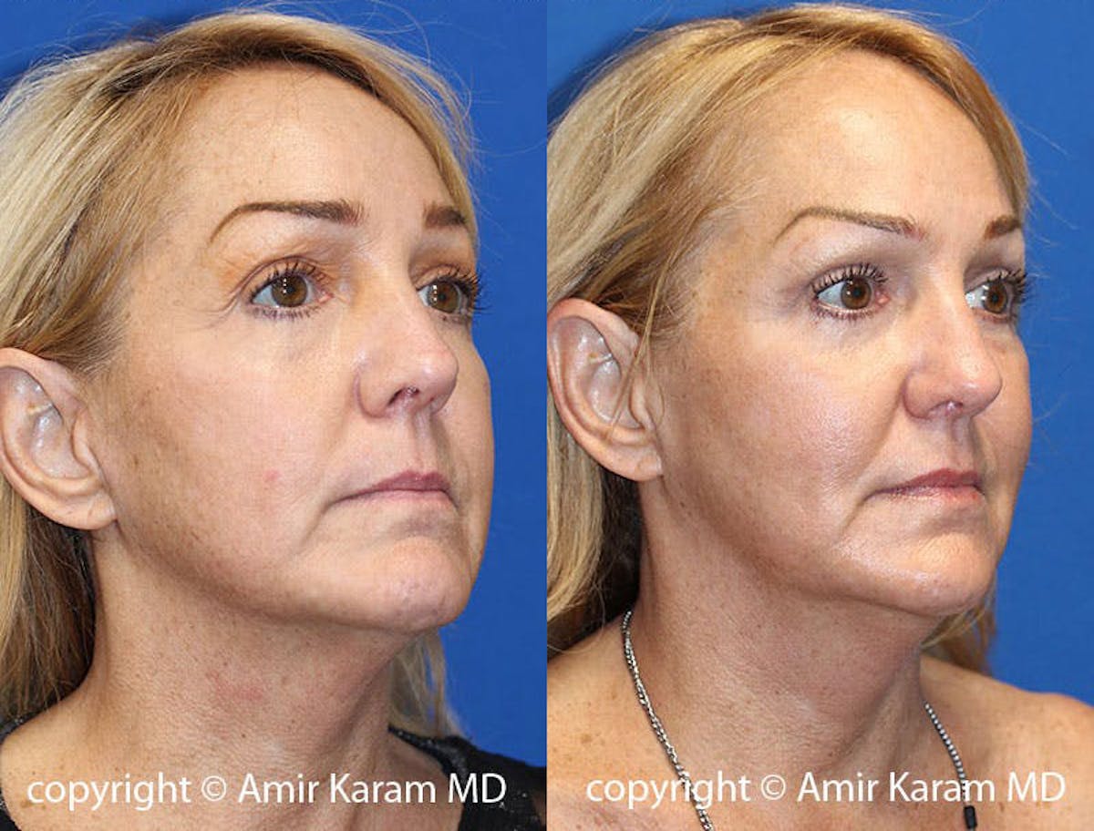 Halo Laser Before & After Gallery - Patient 71701804 - Image 2