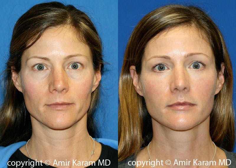 Fat Transfer Before & After Gallery - Patient 71700766 - Image 1