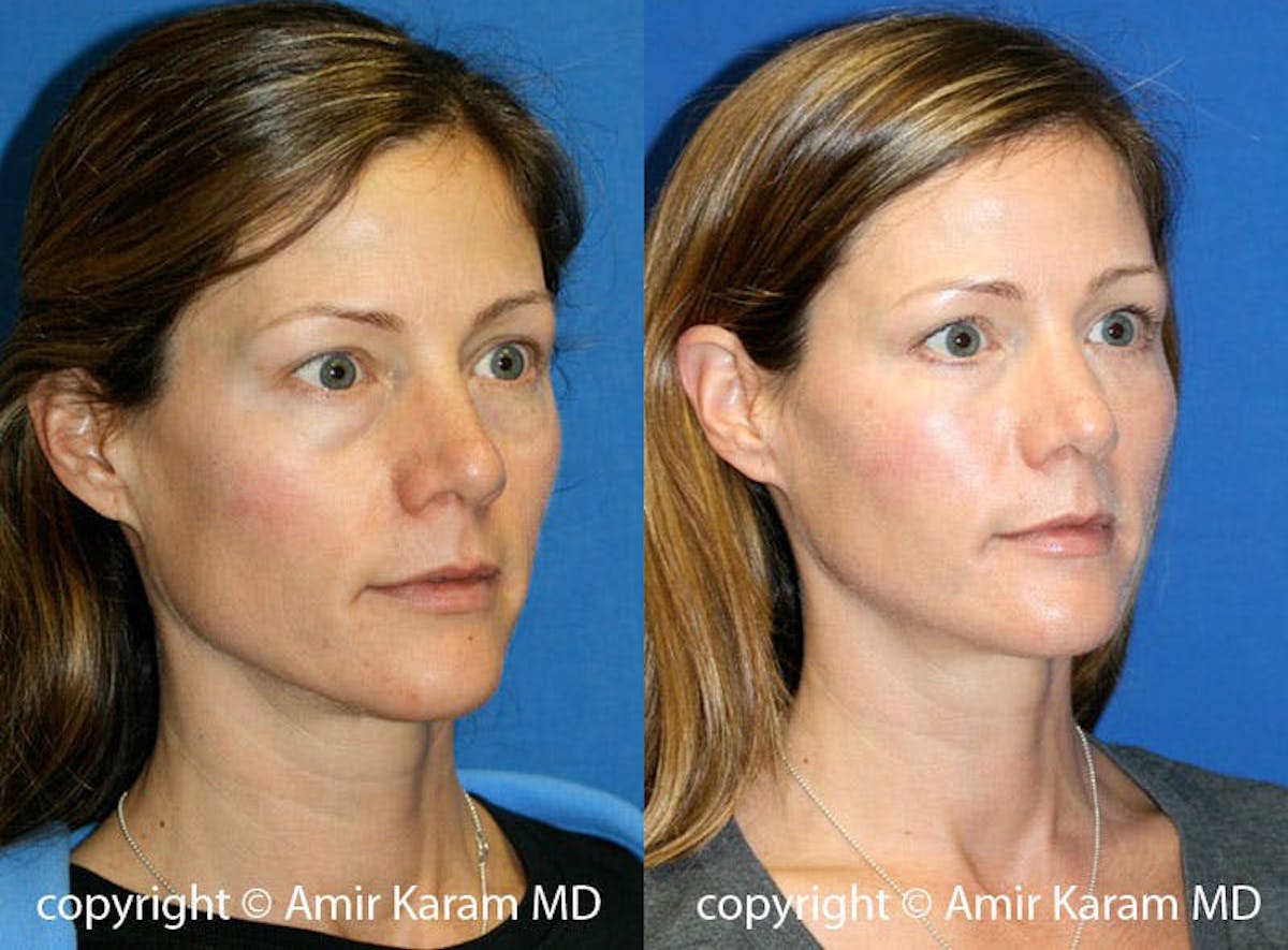 Fat Transfer Before & After Gallery - Patient 71700766 - Image 2