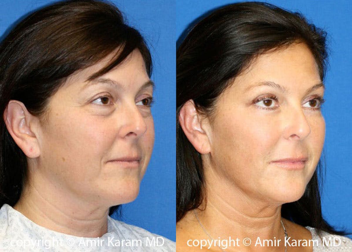 Fat Transfer Before & After Gallery - Patient 71700781 - Image 2