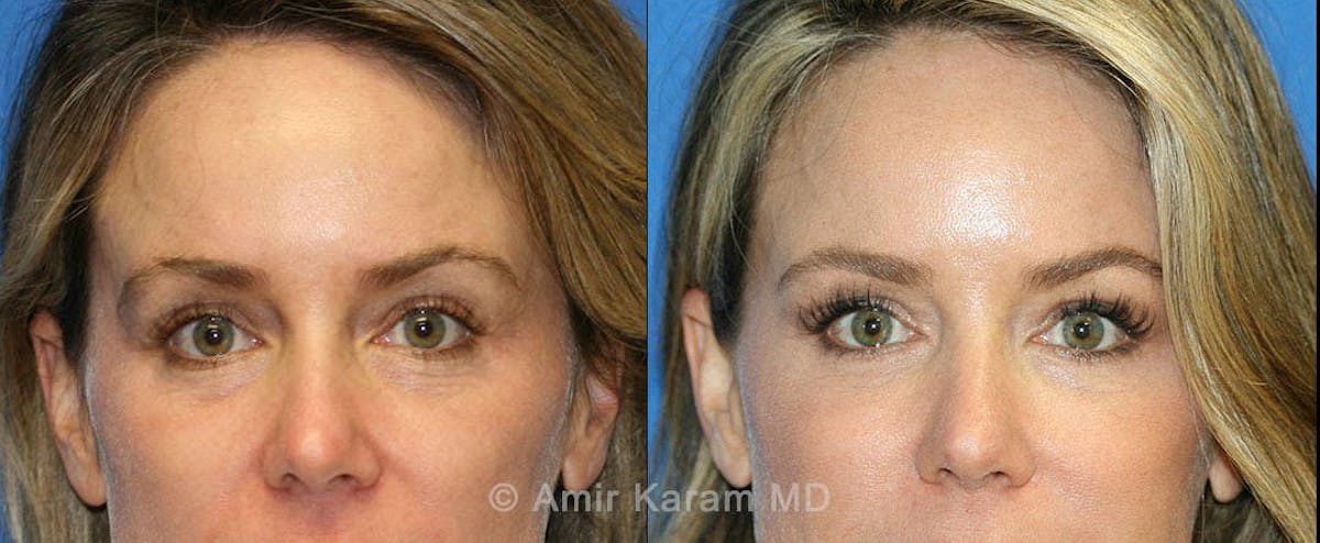 Eye Rejuvenation Before & After Gallery - Patient 71687796 - Image 1