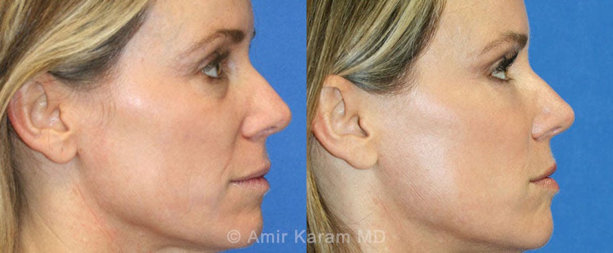 Eye Rejuvenation Before & After Gallery - Patient 71687796 - Image 2