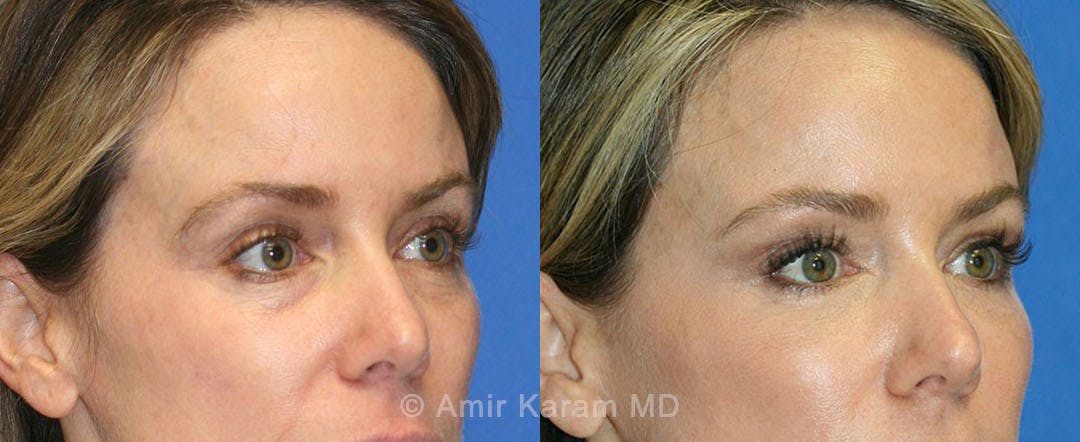Eye Rejuvenation Before & After Gallery - Patient 71687796 - Image 3
