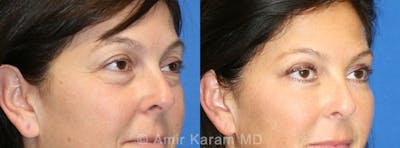 Eye Rejuvenation Before & After Gallery - Patient 71698695 - Image 1